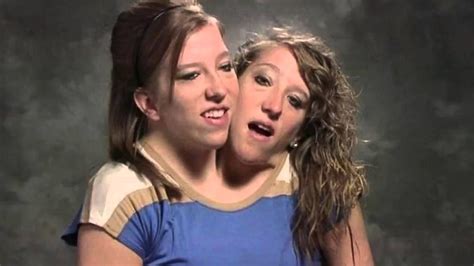 naked conjoined twins|conjoined twins Search